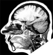 microcephalic brain